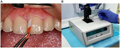 The potential role of the gingival crevicular fluid biomarkers in the prediction of pregnancy complications